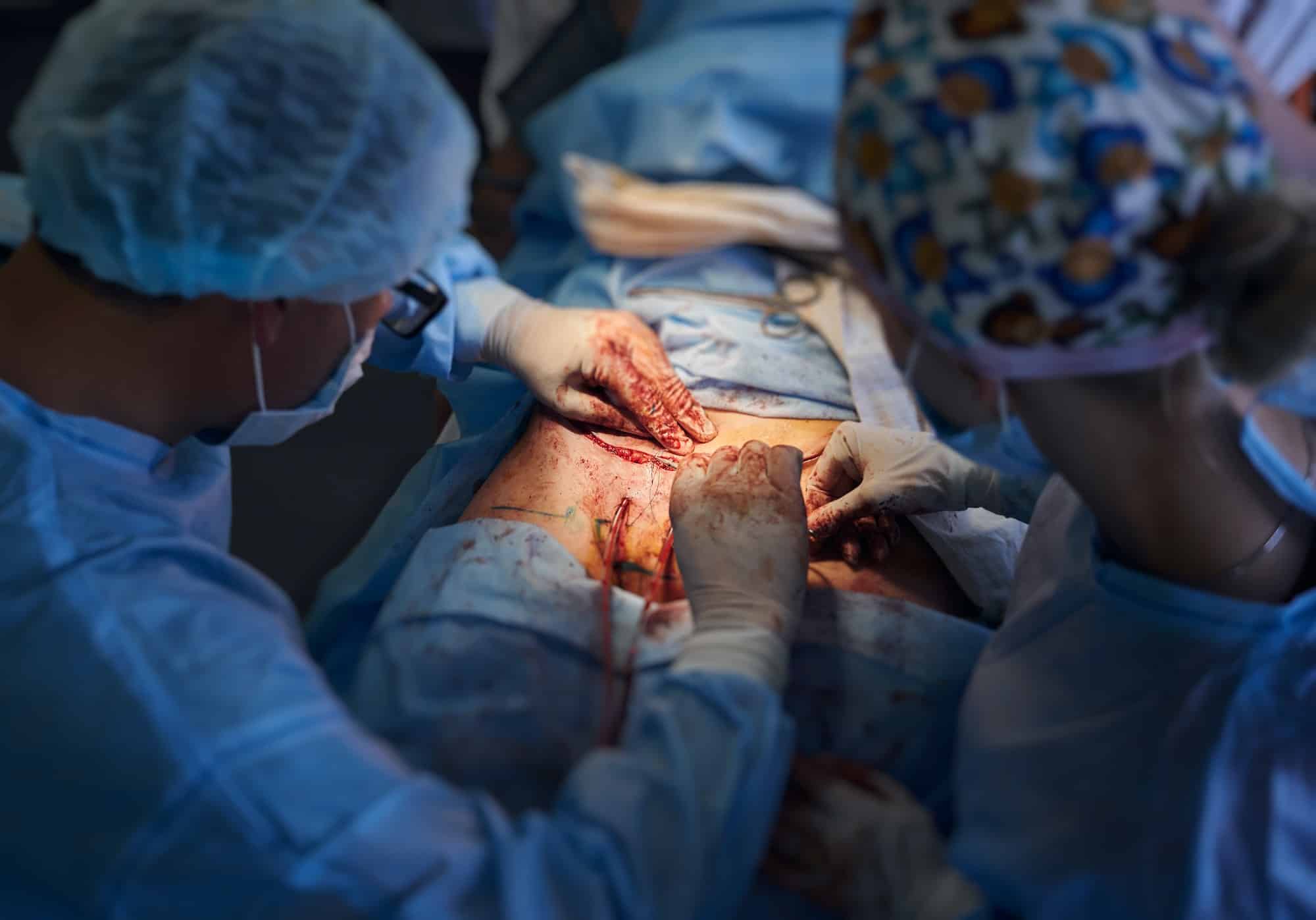 Surgical team performing abdominoplasty surgery in operating room.