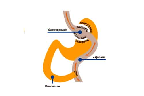 JL Prado Surgical Center's informative flyer detailing their advanced stomach treatment options