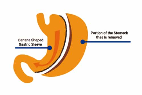 Flyer featuring JL Prado Surgical Center's cutting-edge procedures for stomach-related conditions
