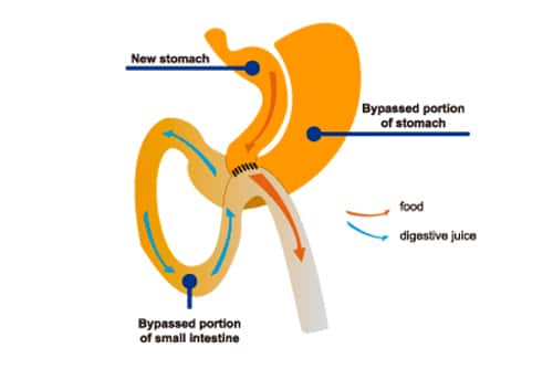 JL Prado Surgical Center's informative flyer detailing their advanced stomach treatment options