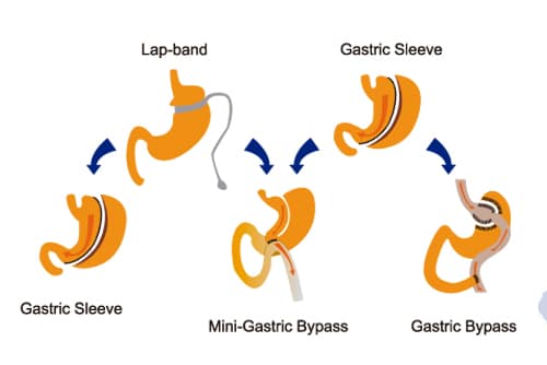 JL Prado Surgical Center's informative flyer detailing their advanced stomach treatment options