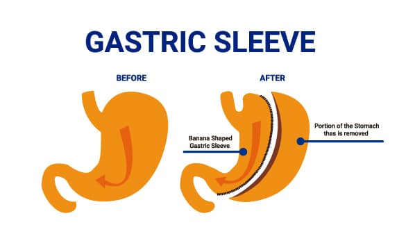 JL Prado Surgical Center's informative flyer detailing their advanced stomach treatment options