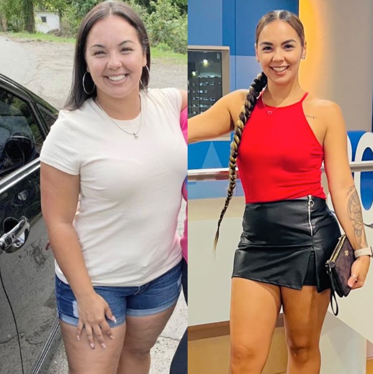 antes y despues de un Tummy Tuck, paciente luciendo fabulosos resultador