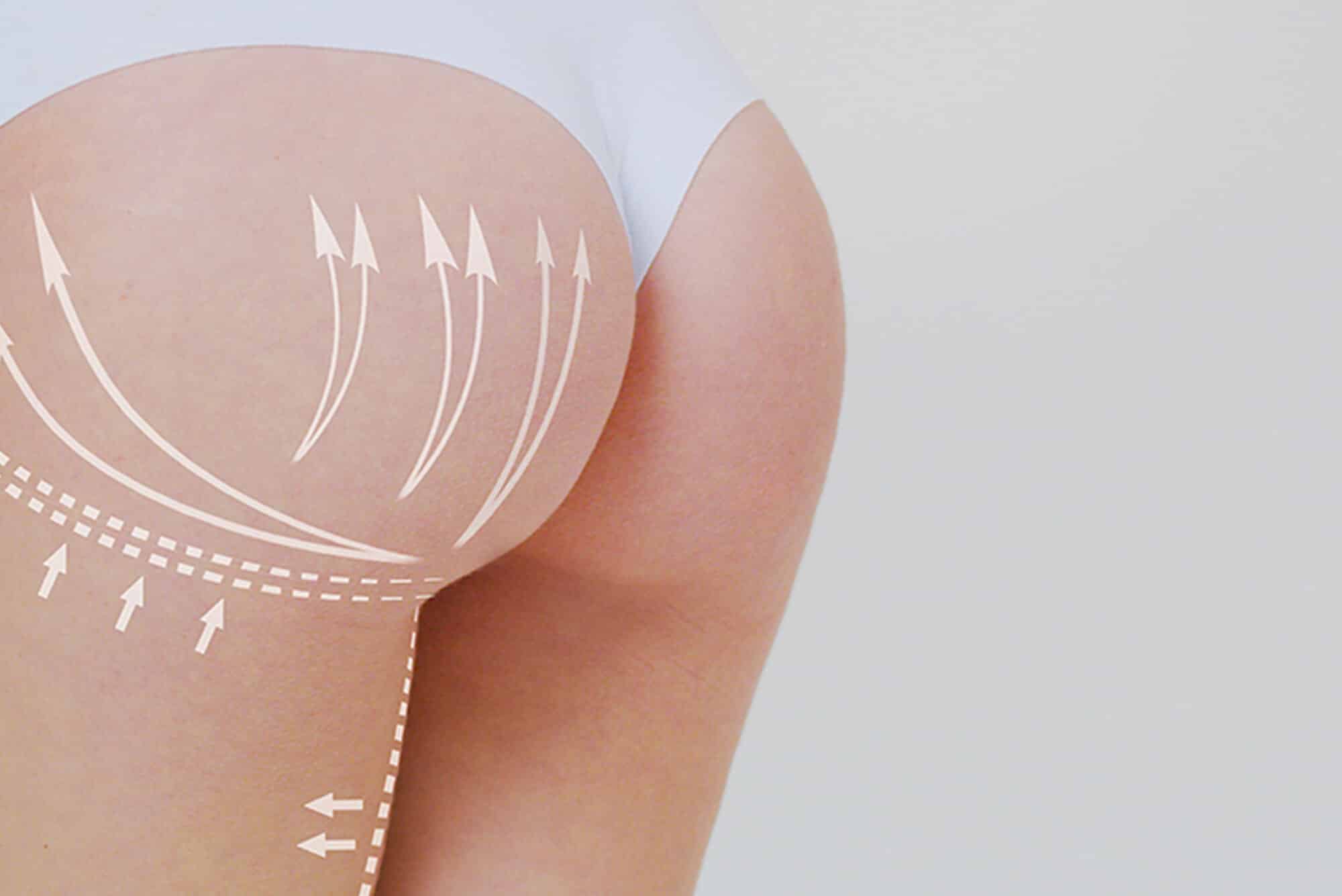 Close-up of a toned and sculpted buttocks after a Brazilian Butt Lift procedure, showcasing natural-looking enhancement.