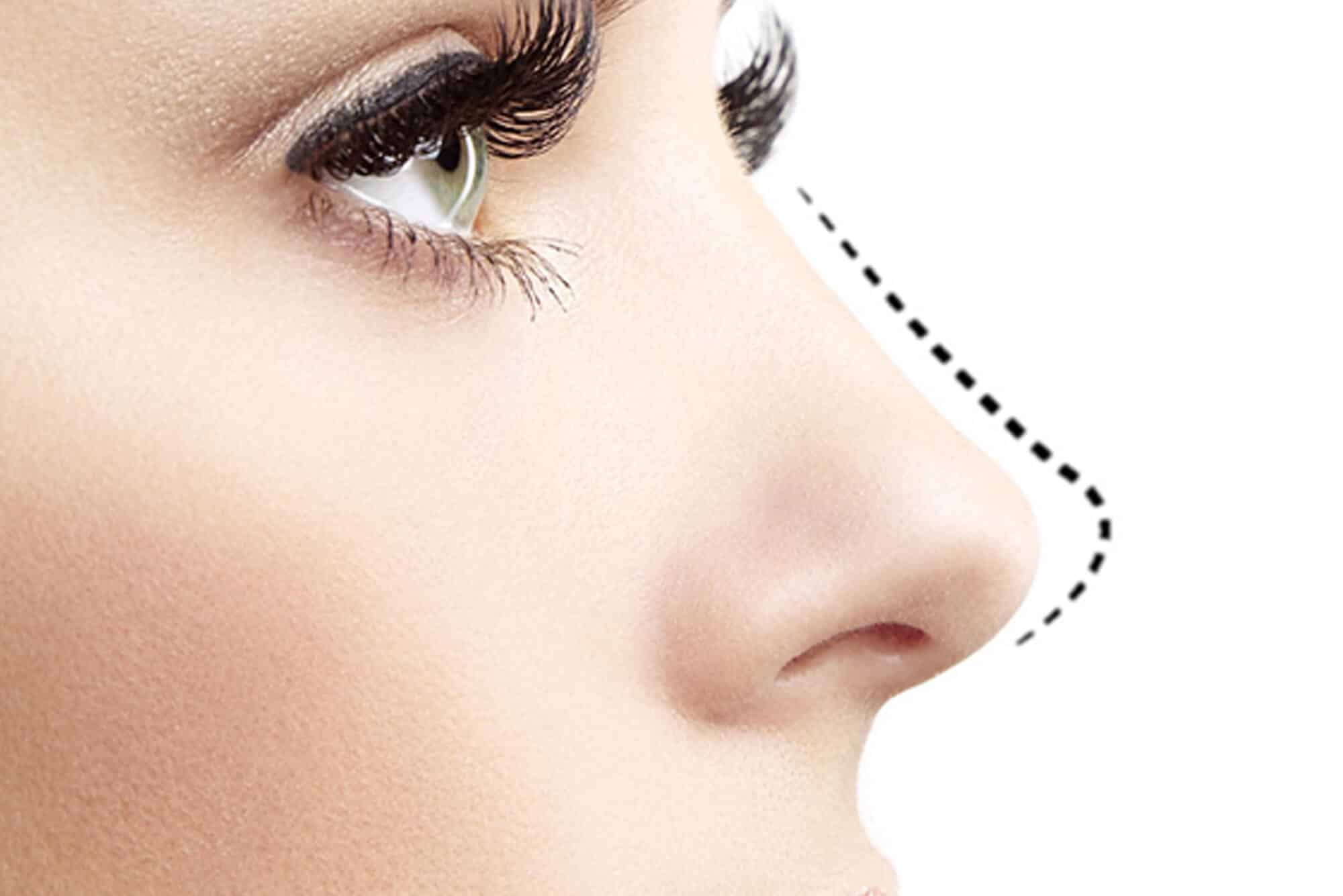 Close-up image of a beautifully contoured nose, a testament to JL Prado Surgical Center's exceptional rhinoplasty results