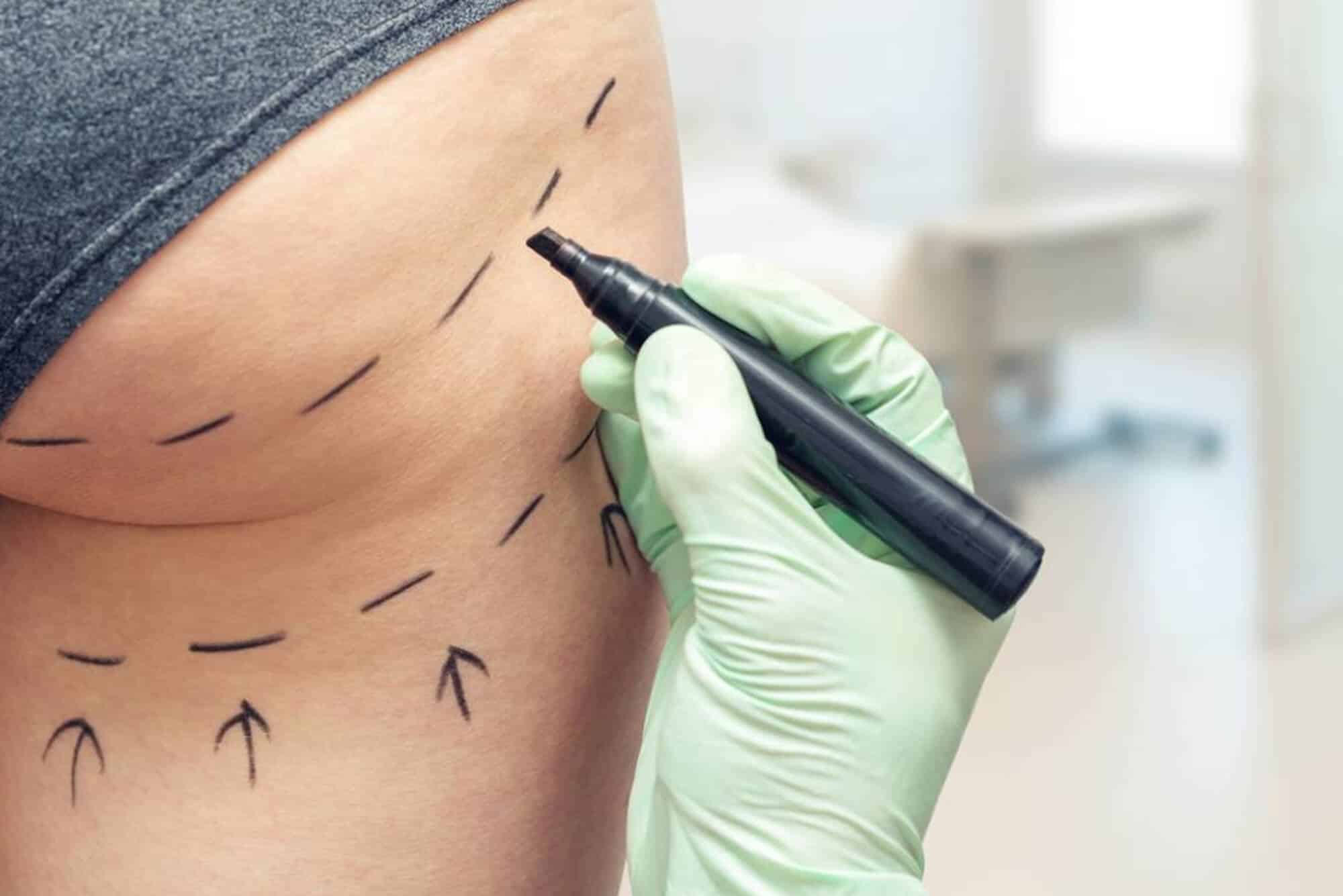 Photograph of a patient with surgical markings indicating planned incision sites at JL Prado