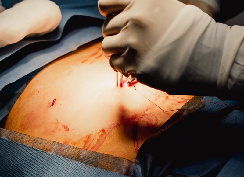 JL Prado's skilled surgical team performing a weight loss procedure