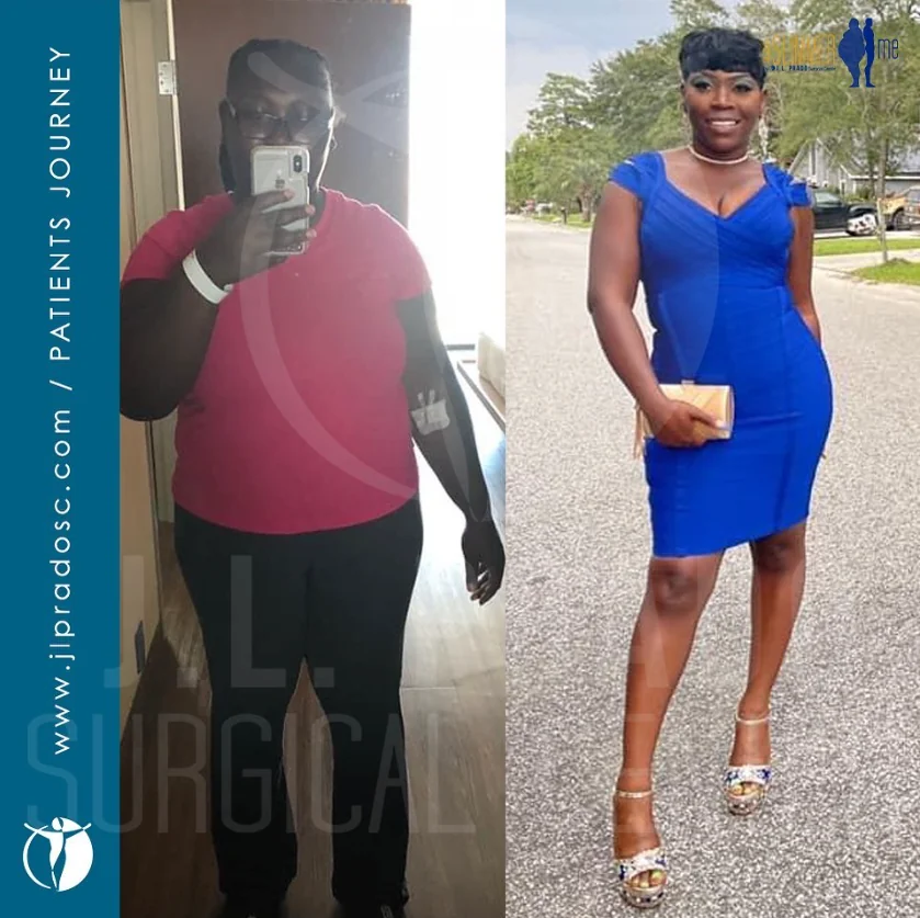 before and after results of a woman who had bariatric surgery and lost a considerable amount of weight