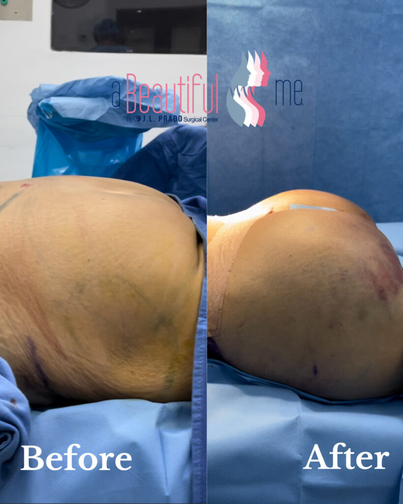 before and after photo showcasing the transformative effects of surgery in Tijuana at JL Prado Surgical Center