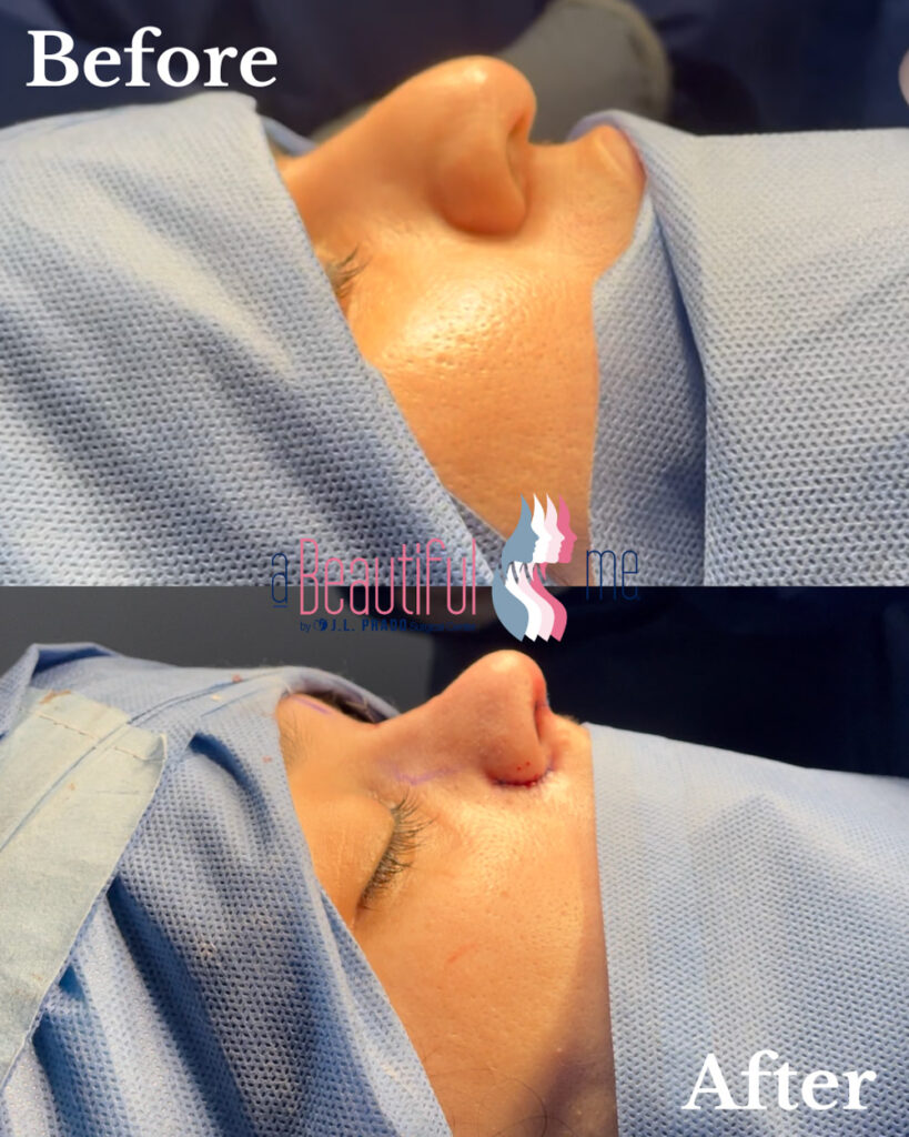 Before and After Image of Rhinoplasty Surgery Showing Remarkable Improvement in Nose Shape and Symmetry.