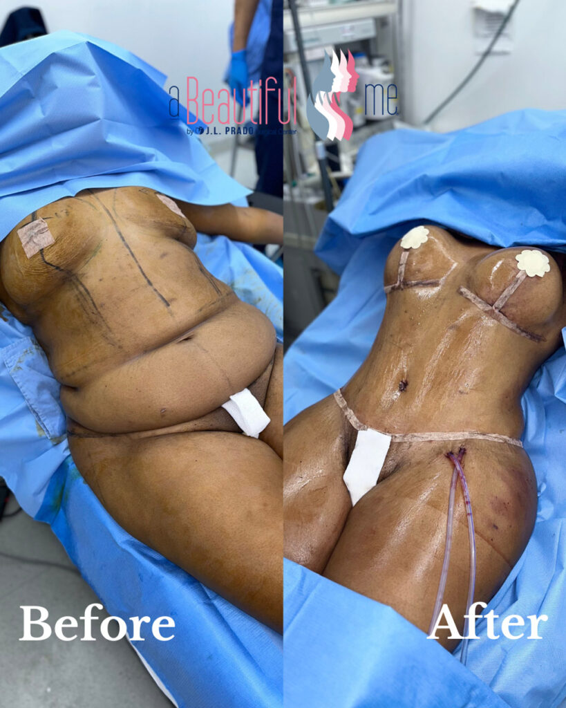 Before-and-after image showcasing the transformative results of a Mommy Makeover surgery.