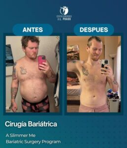 Fotografia antes y despues cirugia bariatrica en tijuana JL Prado 