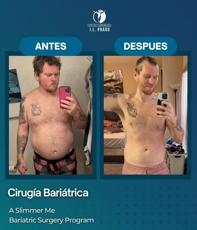 Fotografia antes y despues cirugia bariatrica en tijuana JL Prado