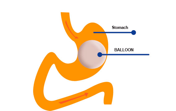 Medical illustration showcasing the gastric balloon placement within the stomach.
