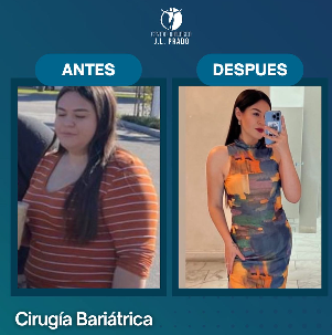 Foto de antes y después de una paciente mostrando una significativa pérdida de peso tras una cirugía de manga gástrica en la Clínica JL Prado.