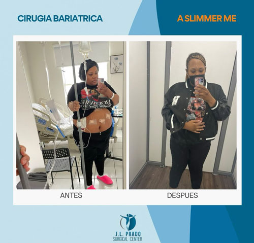 Before and after image of a patient showing the transformation post-bariatric surgery at JL Prado