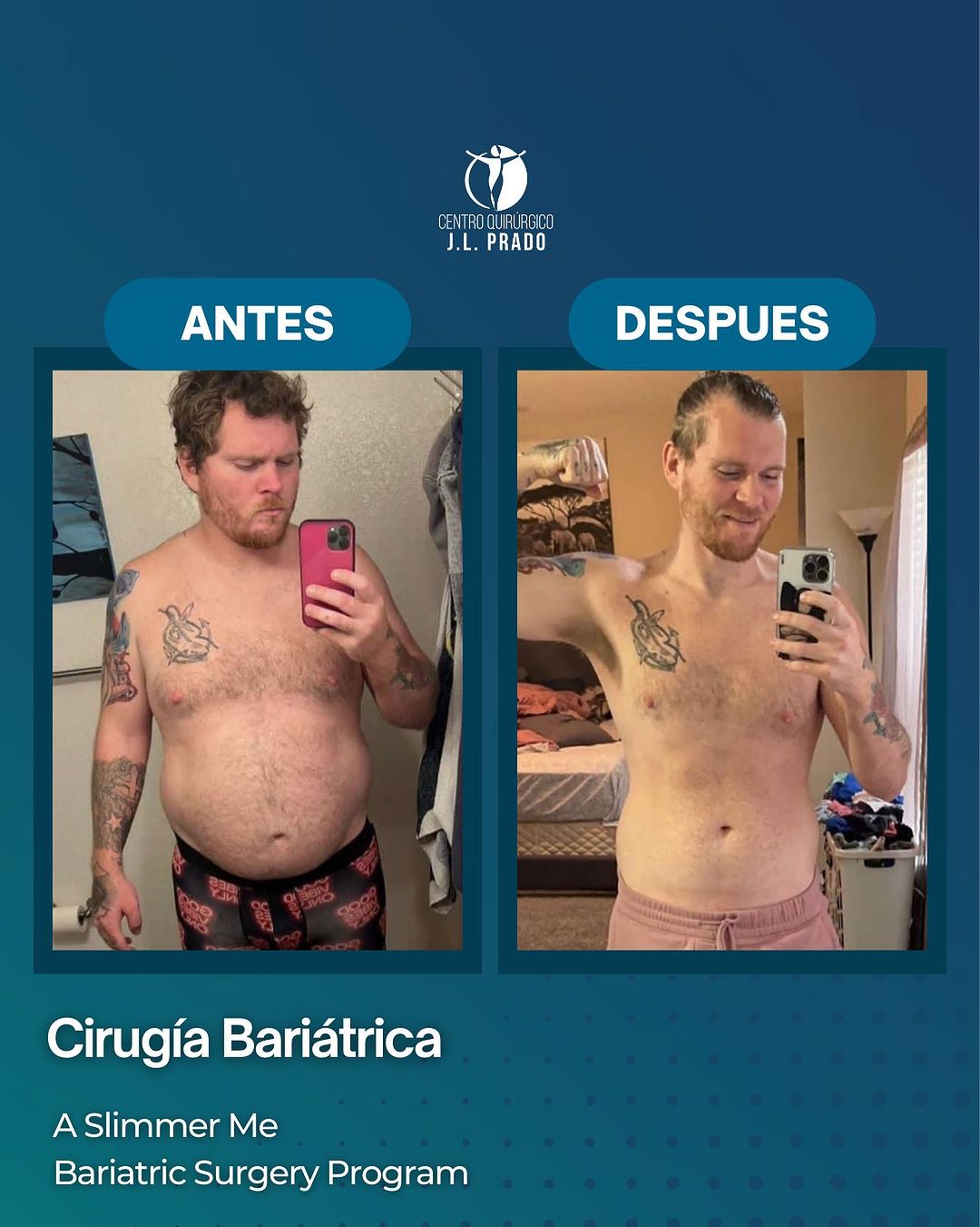 Before and after bariatric surgery at JL Prado, showcasing significant weight loss.