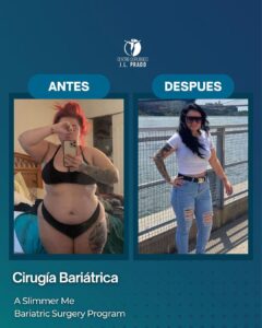 Before and after image of a patient who underwent bariatric surgery at JL Prado Surgical Center. The 'before' photo shows the patient prior to surgery, and the 'after' photo highlights the significant weight loss and transformation achieved through the A Slimmer Me Bariatric Surgery Program.