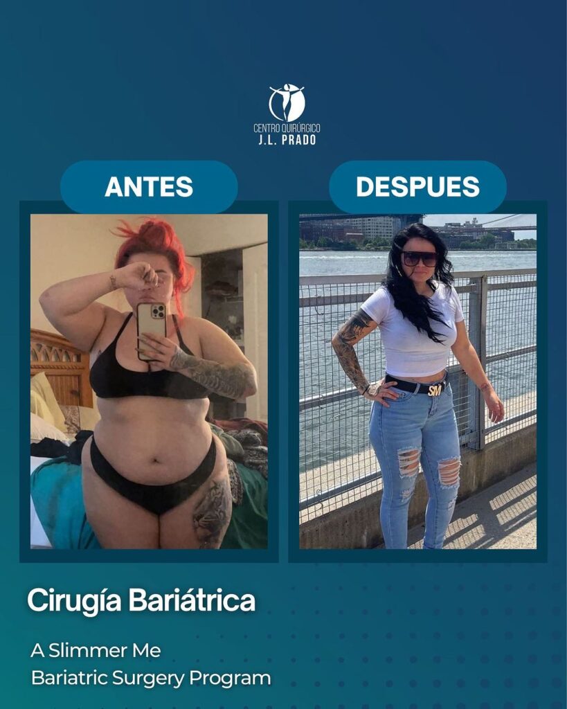 Before and after image of a patient who underwent bariatric surgery at JL Prado Surgical Center. The 'before' photo shows the patient prior to surgery, and the 'after' photo highlights the significant weight loss and transformation achieved through the A Slimmer Me Bariatric Surgery Program.