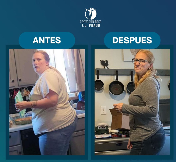 Bariatric Surgery Near Me photos of a patient showing significant weight loss, highlighting the successful results of bariatric surgery at J.L. Prado.