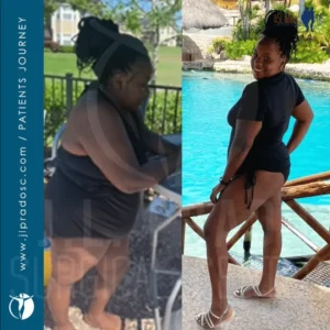 before and after results of a woman who had bariatric surgery and lost a considerable amount of weight