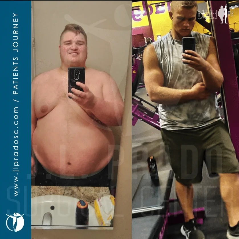 before and after results of a man who had bariatric surgery and lost a considerable amount of weight