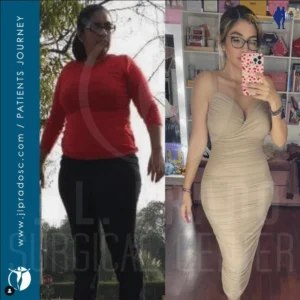 before and after results of a woman who had bariatric surgery and lost a considerable amount of weight