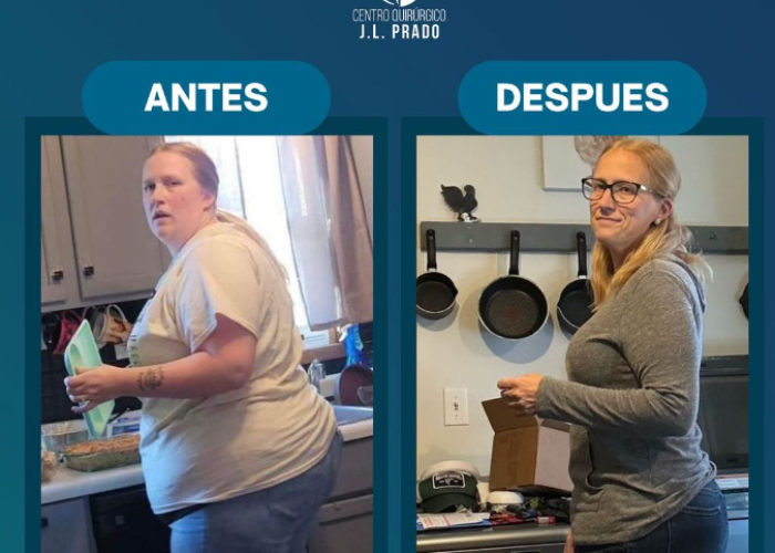 Bariatric Surgery Near Me photos of a patient showing significant weight loss, highlighting the successful results of bariatric surgery at J.L. Prado.