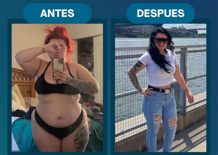 Before and after image of a patient who underwent bariatric surgery at JL Prado Surgical Center. The 'before' photo shows the patient prior to surgery, and the 'after' photo highlights the significant weight loss and transformation achieved through the A Slimmer Me Bariatric Surgery Program.