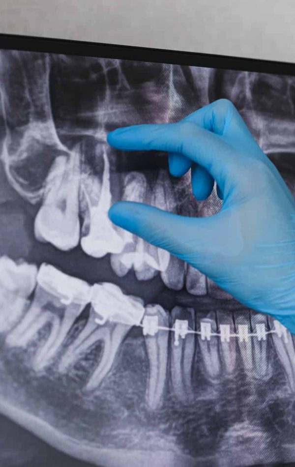 Doctor points to filled root canal in dental x-ray Doctor points to filled root canal in dental x-ray